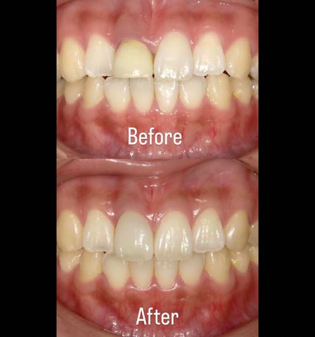 みなさんこんにちは😊KUMAZAWADENTALCLINIC恵比寿です🦷本日は前歯のセラミック治療をされた患者様の症例写真をご紹介します📸右上の前歯が金属にプラスチックをコーティングした前装冠という被せ物でしたが、今回金属を使わないジルコニアセラミックスクラウンという被せ物の種類で作製致しました✨️さらにこちらの患者様はクラウンをつける部分の歯茎を両隣りの歯肉や歯の大きさ、形、バランスを考え綺麗に見えるように歯肉整形致しました😊今回歯肉整形を行ったことで歯茎の位置が左右ときちんと揃い、歯ブラシやケアがしやすくなりました🪥セラミックに変えることで、２次虫歯を防ぐことができます❗️また、セラミックは変色を起こさないため長期にわたって機能するんです✨前歯は特に印象を変える歯なのでまずは虫歯にならないように予防を、虫歯になってしまった場合はまた虫歯になるのを防ぐためにクリニックできちんとご指導させていただきますのでまずはご自身で日々のセルフケアを頑張って予防を頑張っていきましょう☺️#恵比寿#恵比寿西#恵比寿南#目黒#代官山#恵比寿駅#恵比寿歯科#恵比寿歯医者#歯科医院#歯医者#セラミック#恵比寿セラミック#セラミック治療 #インプラント#親知らず#矯正#ホワイトニング#クマザワデンタルクリニック#kumazawadentalclinic恵比寿