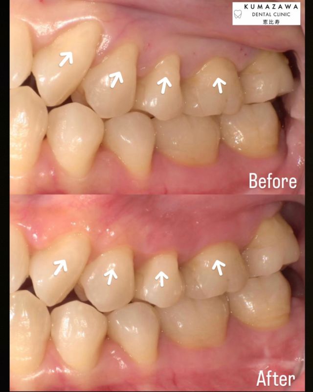 こんにちは😊✨️クマザワデンタルクリニック恵比寿です🦷本日は根面被覆術をされた患者様の症例写真になります。左上の歯茎が下がってしまっているのが根面被覆術によって改善されたのが分かりますね✨️根面被覆とは、さまざまな原因によって下がってしまった歯茎を改善するために露出している歯の根面をカバーすることを治療の目的としています。歯茎が下がることを歯肉退縮といいますが、なぜこのような事が起こってしまうのでしょうか？まず要因として最も多いのが｢歯周病」です‼️歯周病によって歯を支える骨を溶かし、骨を覆っている歯茎は退縮してしまいます。その他にも、歯の磨きすぎや間違ったブラッシング歯ぎしり・食いしばり喫煙加齢など様々な要因がございます。加齢と共に歯肉が下がることももちろんありますが、若い方でも間違ったブラッシングや喫煙などで歯肉退縮になるリスクは沢山ございます。根面被覆は見た目が良くなるだけでなく、知覚過敏が治ったり、歯肉退縮の予防や進行を止める目的があります。 まずは歯肉退縮しないように、日々のセルフケアをご自身で頑張っていただき定期的な検診とクリーニングをきちんと受けることをおすすめしております🙆‍♀️気になることがございましたらお気軽にご相談くださいね✨#恵比寿#恵比寿西#恵比寿南#目黒#代官山#恵比寿駅#恵比寿歯科#恵比寿歯医者#歯科医院#歯医者#サイナスリフト#セラミック#恵比寿セラミック#セラミック治療 #インプラント#親知らず#矯正#ホワイトニング#クマザワデンタルクリニック#kumazawadentalclinic恵比寿