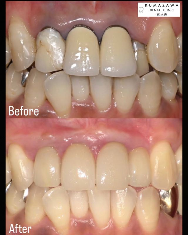 こんにちは😊クマザワデンタルクリニック恵比寿です🦷こちらの症例写真の患者様は、セラミック治療を行う際に奥まった左上2番の歯を矯正をせずに前に出し歯列・歯肉のラインを整える治療(BTAテクニック)と上の歯茎の黒ずんでいる部分を元々前歯の部分に立てていた土台のメタルコアを除去しグラスが素材のファイバーコアに土台を変えて立て直し、歯肉結合組織を口蓋側から移植し歯肉の厚みを出して、透けている歯根色を歯肉移植をすることで改善しました。歯茎のラインを整えるには、歯茎を切って骨を削ったり電気メスで歯茎のラインをカットしたりするのですがBTAテクニックだと歯周外科を必要とせず、歯肉の形を被せ物によって整えることが出来るんです😲被せ物を新しいものに変え、歯肉のラインを整えて前歯の歯茎の部分も色が綺麗なピンクに戻り、全体的にとても印象が変わりましたね☺️✨歯茎の黒ずみや、ラインを綺麗に治したいなど気になることがございましたらいつでもご連絡・ご相談お待ちしております❕#恵比寿#恵比寿西#恵比寿南#目黒#代官山#恵比寿駅#恵比寿歯科#恵比寿歯医者#歯科医院#歯医者#サイナスリフト#セラミック#恵比寿セラミック#セラミック治療 #インプラント#親知らず#矯正#ホワイトニング#クマザワデンタルクリニック#kumazawadentalclinic恵比寿
