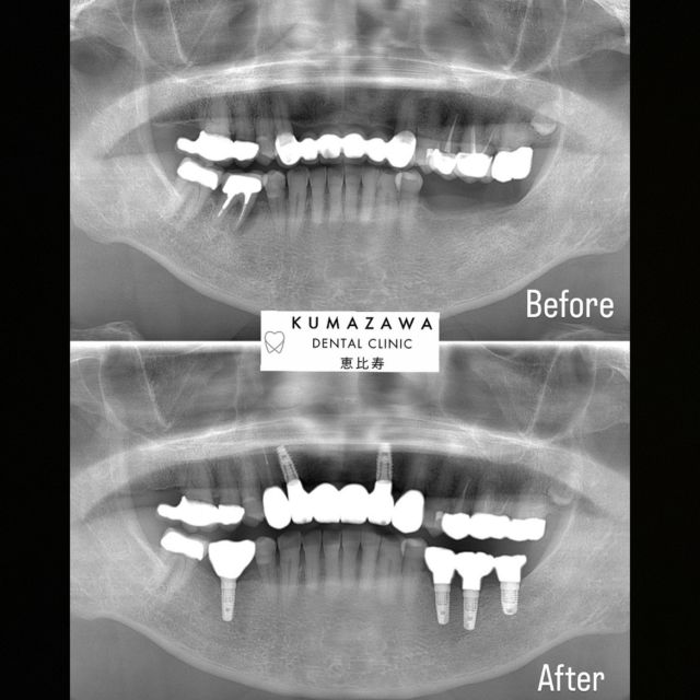 こんにちは😊クマザワデンタルクリニック恵比寿です🦷本日はインプラントを埋入した患者様のレントゲンの症例写真をご紹介します📸こちらの患者様は上顎に2本、下顎に4本インプラントを埋入致しました😊左下は義歯を使っていましたが、インプラントを埋入したので自分の歯と同じような感覚でしっかりと噛むことができるようになりました🙆‍♀️✨自分の歯を失ってしまい入れ歯にした場合、違和感やしっかりと物を噛めないというような感覚で悩んでいる方も珍しくはないとおもいます。インプラントは、失った歯の根っこの代わりに人工歯根を埋め込みそれを土台として人工歯を取り付けます。そのため天然の歯と同じような感覚でしっかりと噛むことができるんです🦷そしてインプラントの1番のメリットは今残っているご自身の健康な他の歯に負担をかけずに済むという点です✨入れ歯やブリッジという選択肢の場合、残っている歯を削ったり両隣の支える歯に負担がかかったりしてしまいます。虫歯や歯周病で歯を抜かなくてはいけなくなってしまったなどご自身の歯がなくなってしまう場合、どうすればいいのか当然悩まれると思います。患者様のご希望に沿って治療を進めご説明・ご提案をきちんとさせていただきますので、不安なことがございましたらお気軽にご相談ください✨#恵比寿#恵比寿西#恵比寿南#目黒#代官山#恵比寿駅#恵比寿歯科#恵比寿歯医者#歯科医院#歯医者#サイナスリフト#セラミック#恵比寿セラミック#セラミック治療 #インプラント#親知らず#矯正#ホワイトニング#クマザワデンタルクリニック#kumazawadentalclinic恵比寿
